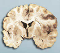 neuropath