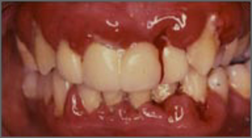 Abb.: Schmerzhafte Gingivitis mit Parodontalabszeßen