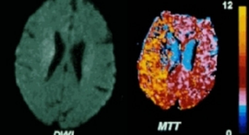 Akuter Hirninfarkt / Infarkt nach 5 Tagen