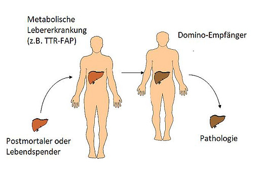 FAP Amyloidose nach Domino-Lebertransplantation