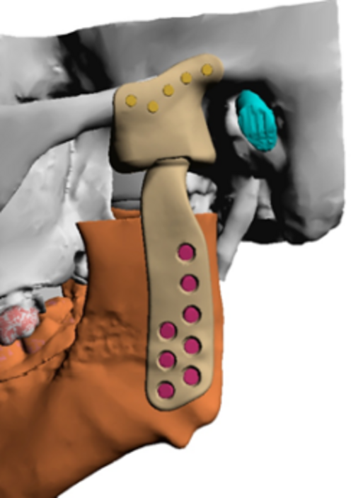 Abb. 6 Patientenspezifische Kiefergelenktotalendoprothese links