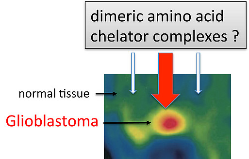 Glioblastoma