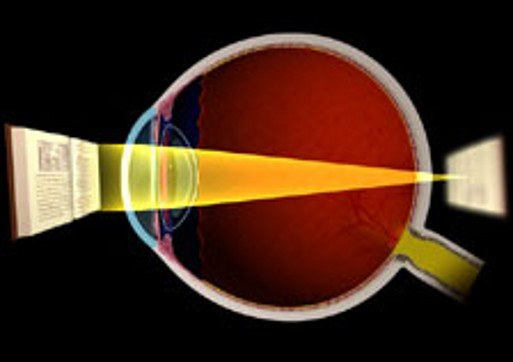 Weitsichtigkeit (Hyperopie)