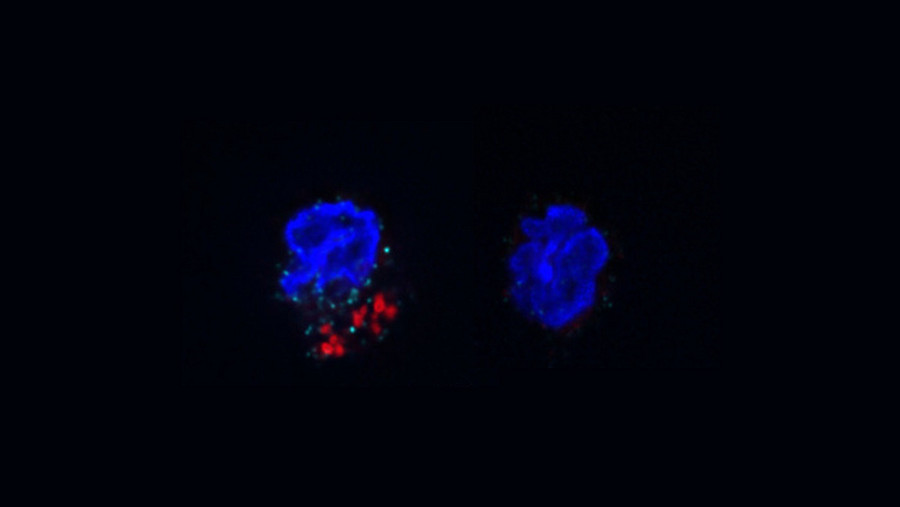 ACC-mediated FAS is required for IL-17A expression in γδT17 cells under psoriatic conditions.