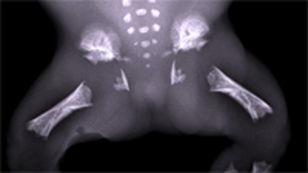 Thanatophore Dysplasie Typ II, Radiologische Aufnahme