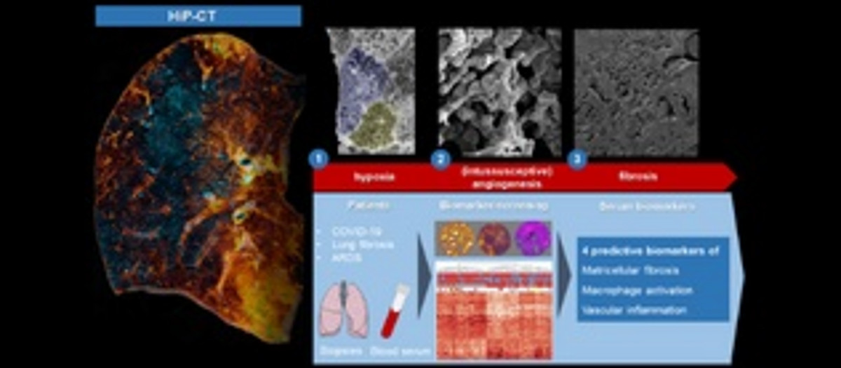 Long COVID and pulmonary fibrosis better understood thanks to ...