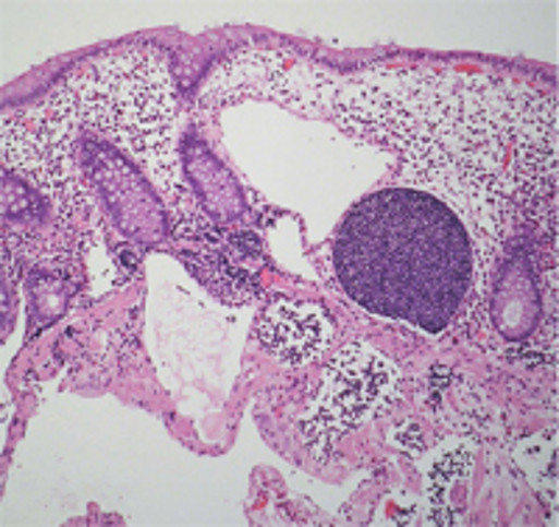 H&E-Färbung einer intestinalen Lymphangiektasie