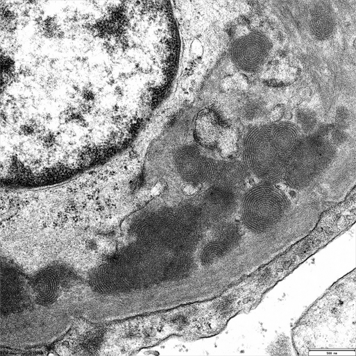 Nierenbiopsie bei einem Patienten mit Lupus erythematodes