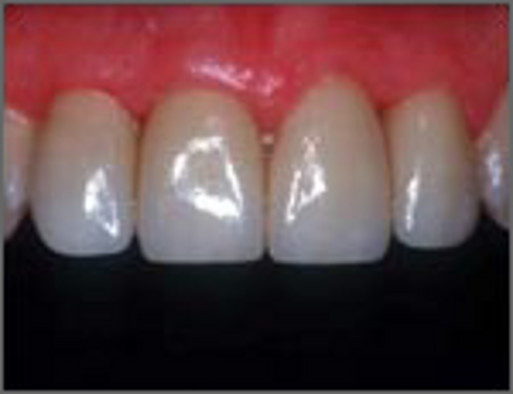 Zähne mit Verfärbungen und Schmelzschäden nach Versorgung mit Veneers