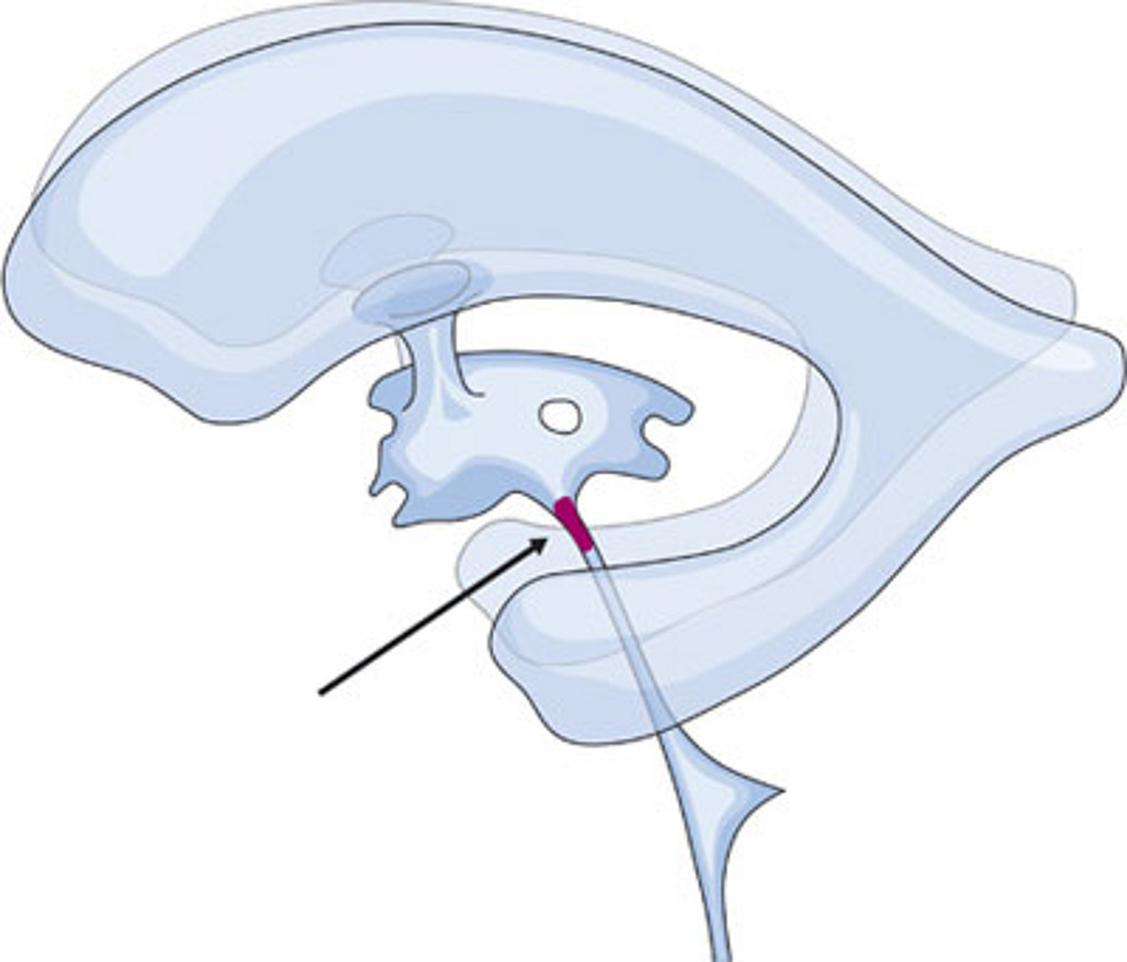 Okklusivhydrozephalus