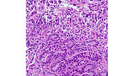 Histopathologische Aufnahmen von Tumorzellen sind ein zentraler Bestandteil der Krebsdiagnostik. Quelle: S. Försch