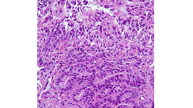 Histopathologische Aufnahmen von Tumorzellen sind ein zentraler Bestandteil der Krebsdiagnostik. Quelle: S. Försch