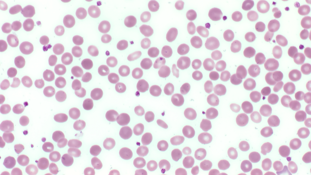 Blutbild eines Patienten mit Varianten in SPTA1 (Hereditäre Sphärozytose) und PIEZO1 (Hereditäre Stomatozytose) (Panoptische Färbung nach Pappenheim)