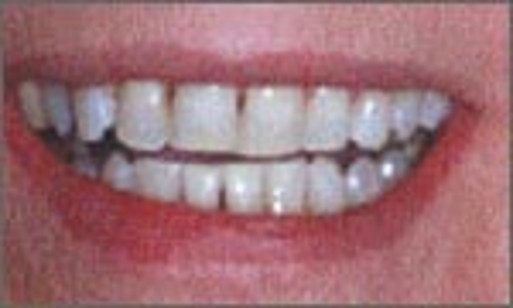 Zähne nach "in-office-Bleaching"