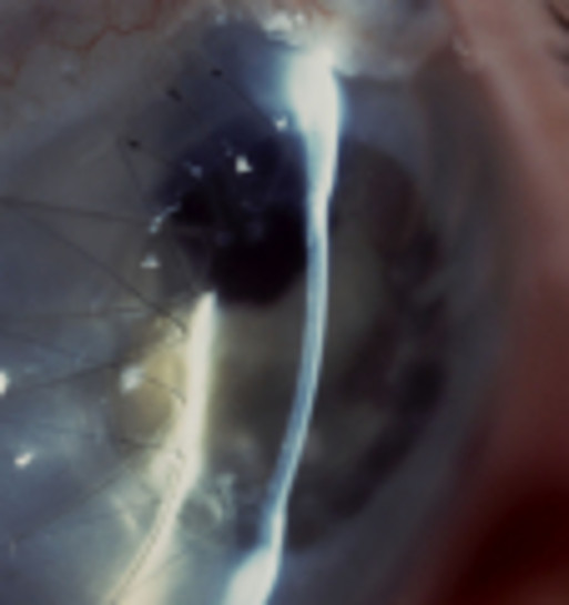 Hornhauttransplantation