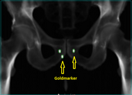 Prostata Goldmarker