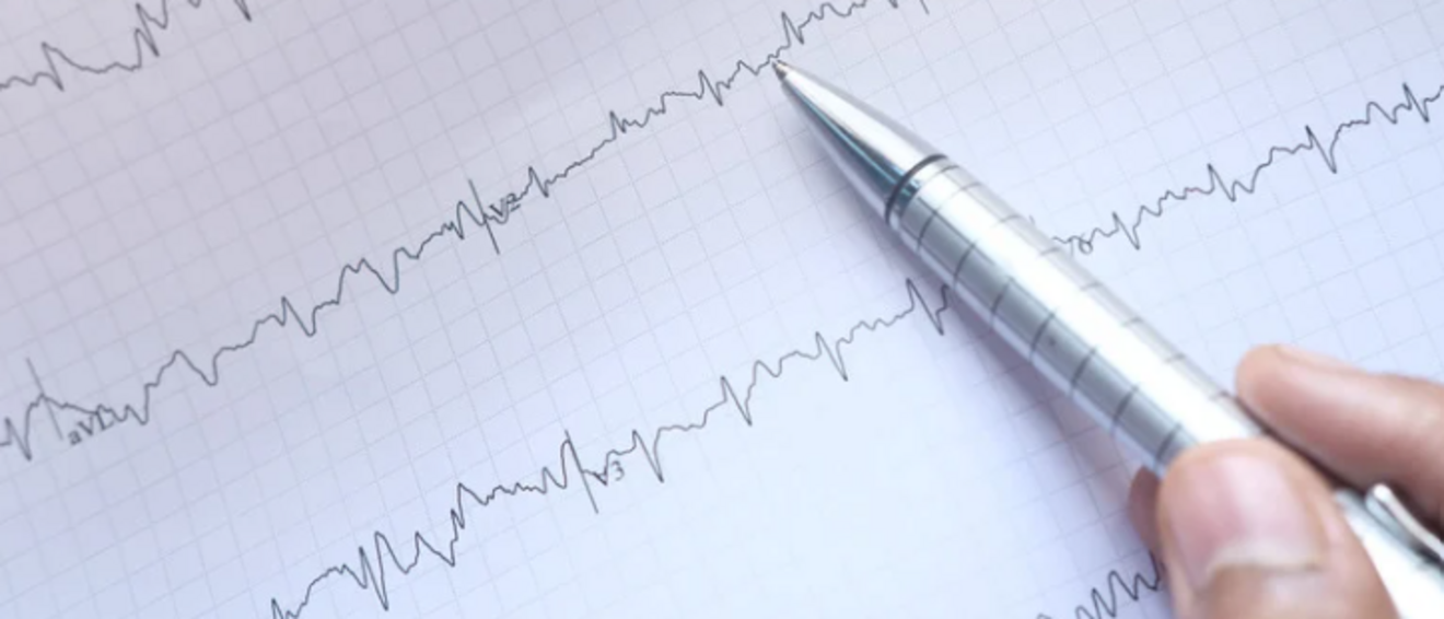 EKG