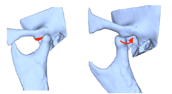 Abb. 5 Teilabtragung des Tuberculum articulare (rot) zur Erleichterung der spontaten Reposition des Kondylus nach Luxation