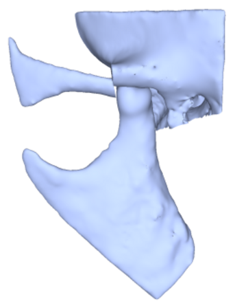 Abb. 3 Verriegelungsplastik nach LeClerc u. Girard via distaler Osteotomie und Kaudalverlagerung des Jochbogens