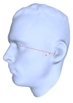 Abb. 1 Zugangspunkte zum Kiefergelenk für die Arthroskopie und Arthrozentese
