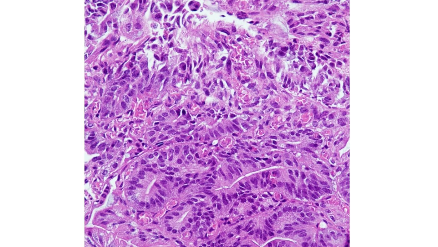 Histopathologische Aufnahmen von Tumorzellen sind ein zentraler Bestandteil der Krebsdiagnostik. Quelle: S. Försch